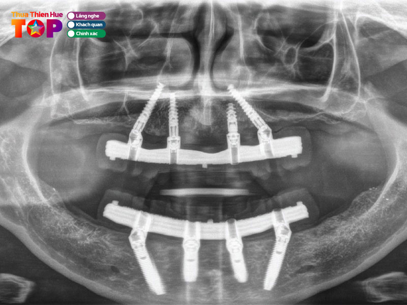 Loi-ich-cua-viec-trong-rang-implant-1-huetoplist