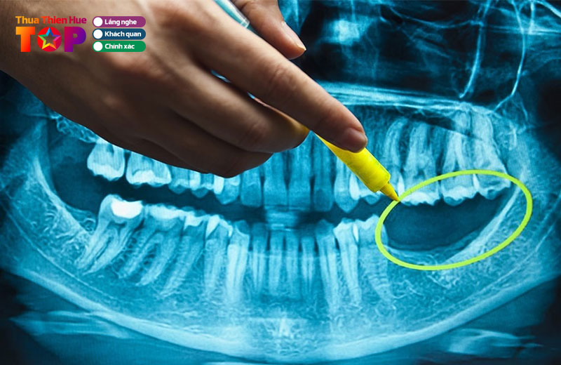 Loi-ich-cua-viec-trong-rang-implant-huetoplist